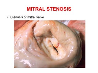 MITRAL STENOSIS
• Stenosis of mitral valve
 