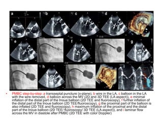 • PMBC step-by-step: a transseptal puncture (x-plane), b wire in the LA, c balloon in the LA
with the wire removed, d balloon across the MV (2D and 3D TEE (LA aspect)), e minimal
inflation of the distal part of the Inoue balloon (2D TEE and fluoroscopy), f further inflation of
the distal part of the Inoue balloon (2D TEE/fluoroscopy), g the proximal part of the balloon is
also inflated (2D TEE and fluoroscopy), h maximum inflation of the proximal and the distal
part of the Inoue balloon (2D TEE/ fluoroscopy/ 3D TEE (LA aspect)), and i laminar flow
across the MV in diastole after PMBC (2D TEE with color Doppler)
 