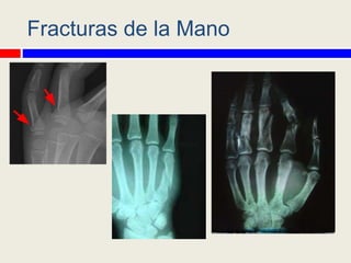 1-lunes-generalidades-de-fracturas-en-ni-os-con-audio-pptx