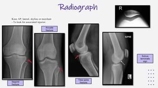 Normal Merchant Radiograph 1.Update on ACL injuries and management NOOR AZMI MN (2).pptx