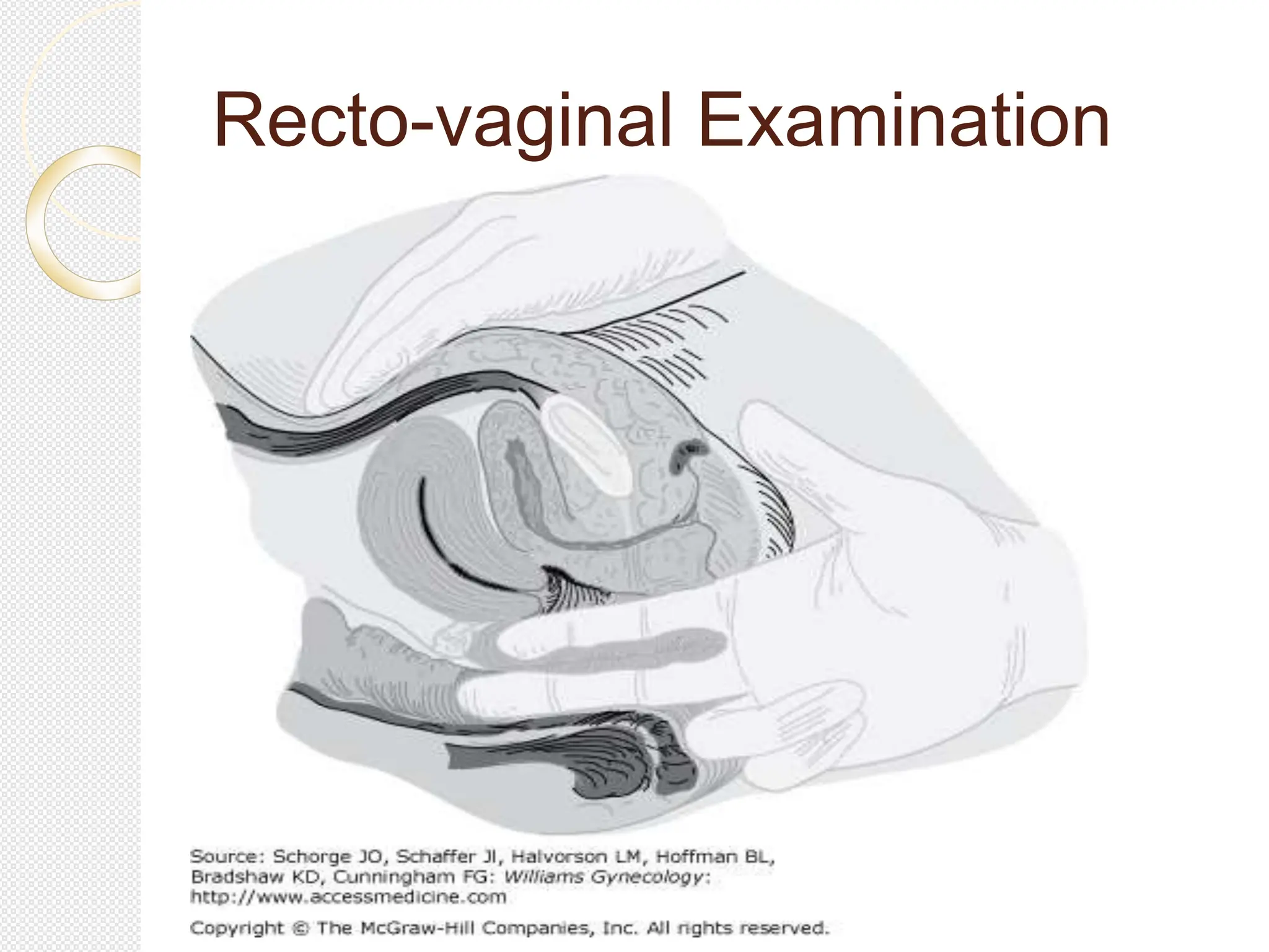 Recto-vaginal Examination
 
