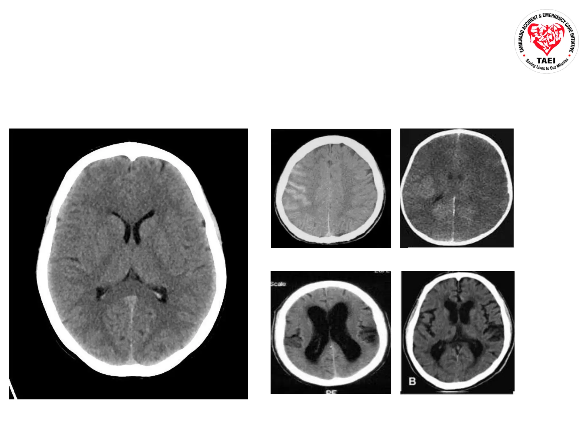 Psychiatry Traumatic Brain Injury Ppt Ppt Ppt