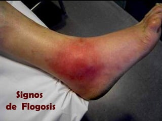 Signos
de Flogosis
 