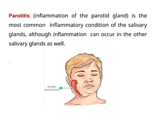 1.3)Salivary gland disorder by khyber medical university l | PPTX