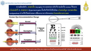 ครูวิชัยลิขิตพรรักษ์ ตาแหน่งครู วิทยฐานะครูชานาญการพิเศษ(คศ.3)กลุ่มสาระการเรียนรู้วิทยาศาสตร์และเทคโนโลยี โรงเรียนวัดราชบพิธ สพม.กท.1
สถาบันส่งเสริมการสอนวิทยาศาสตร์และเทคโนโลยี
ความผิดปกติ 1. สายตาสั้น (myopia) กระบอกตายาวเกินไป เลนส์หรือ cornea โค้งมาก
แว่นเลนส์เว้า 2. สายตายาว (hypermetropia) สั้นเกินไปหรือโค้งน้อย แว่นเลนส์นูน 3.สายตาเอียง
(astigmatism) ส่วนโค้งไม่สม่าเสมอ เปลี่ยนแนวการหักเหแสงแว่นเลนส์ทรงกระบอก
 