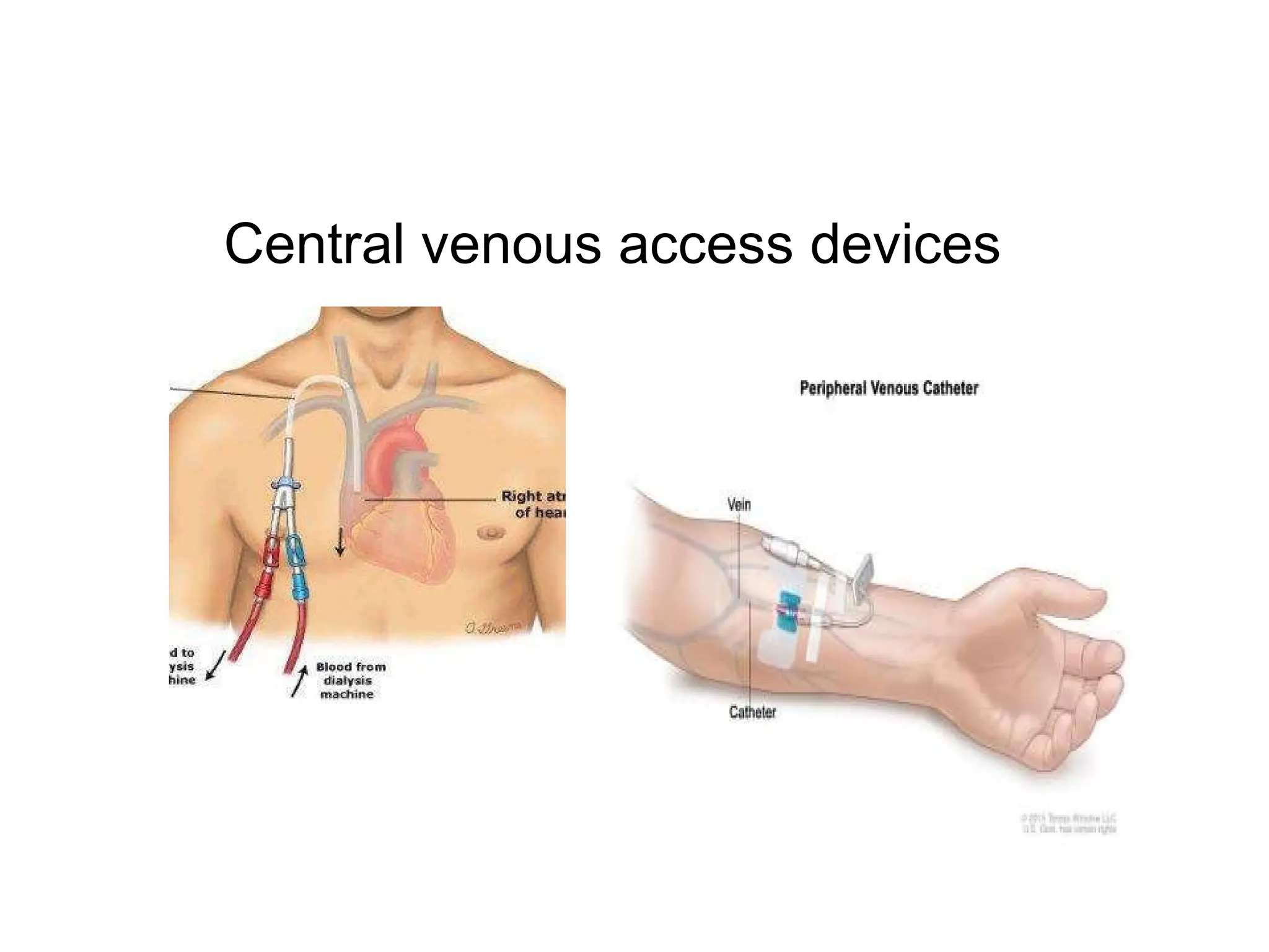 Central venous access devices
 