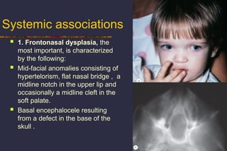 Systemic Cleft 1. ON Anomalies.ppt for ophthalmology students | PPT
