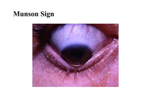 Munson Sign
 