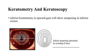 Keratometry And Keratoscopy
• inferior keratometry in upward gaze will show steepening in inferior
cornea
 