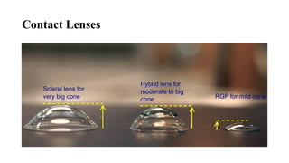 Contact Lenses
 