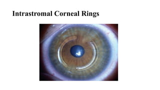 Intrastromal Corneal Rings
 
