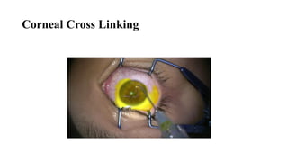 Corneal Cross Linking
 