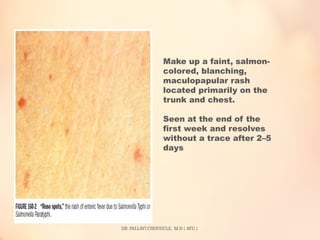 Salmon Like Rash Typhoid Fever- Dr. Pallavi Chougule, M. D (RNVV) | PPTX