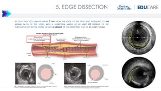 Edge Dissection G. Gasparini - Interactive Case based learning using IVUS123 | PDF