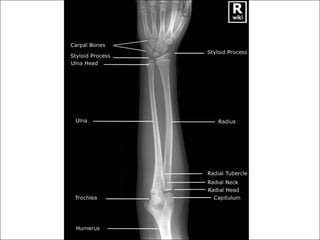 1.2 Upper Limb.pdf anatomy of the upper limb | PDF