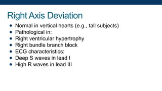 Right Axis Deviation
● Normal in vertical hearts (e.g., tall subjects)
● Pathological in:
● Right ventricular hypertrophy
● Right bundle branch block
● ECG characteristics:
● Deep S waves in lead I
● High R waves in lead III
 