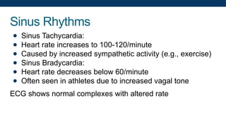 Sinus Rhythms
● Sinus Tachycardia:
● Heart rate increases to 100-120/minute
● Caused by increased sympathetic activity (e.g., exercise)
● Sinus Bradycardia:
● Heart rate decreases below 60/minute
● Often seen in athletes due to increased vagal tone
ECG shows normal complexes with altered rate
 