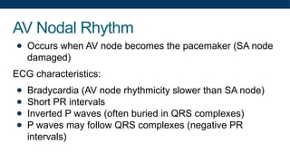 AV Nodal Rhythm
● Occurs when AV node becomes the pacemaker (SA node
damaged)
ECG characteristics:
● Bradycardia (AV node rhythmicity slower than SA node)
● Short PR intervals
● Inverted P waves (often buried in QRS complexes)
● P waves may follow QRS complexes (negative PR
intervals)
 