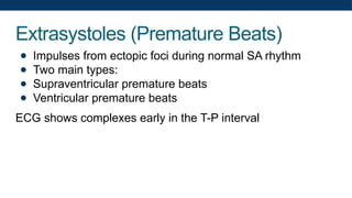 Extrasystoles (Premature Beats)
● Impulses from ectopic foci during normal SA rhythm
● Two main types:
● Supraventricular premature beats
● Ventricular premature beats
ECG shows complexes early in the T-P interval
 