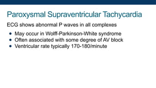 Paroxysmal Supraventricular Tachycardia
ECG shows abnormal P waves in all complexes
● May occur in Wolff-Parkinson-White syndrome
● Often associated with some degree of AV block
● Ventricular rate typically 170-180/minute
 