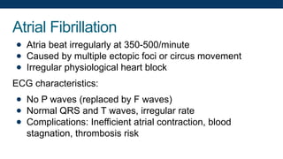 Atrial Fibrillation
● Atria beat irregularly at 350-500/minute
● Caused by multiple ectopic foci or circus movement
● Irregular physiological heart block
ECG characteristics:
● No P waves (replaced by F waves)
● Normal QRS and T waves, irregular rate
● Complications: Inefficient atrial contraction, blood
stagnation, thrombosis risk
 