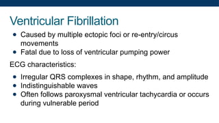 Ventricular Fibrillation
● Caused by multiple ectopic foci or re-entry/circus
movements
● Fatal due to loss of ventricular pumping power
ECG characteristics:
● Irregular QRS complexes in shape, rhythm, and amplitude
● Indistinguishable waves
● Often follows paroxysmal ventricular tachycardia or occurs
during vulnerable period
 
