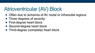 Atrioventricular (AV) Block
● Often due to ischemia of AV nodal or infranodal regions
● Three degrees of severity:
● First-degree heart block
● Second-degree heart block
● Third-degree (complete) heart block
 