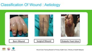 Wound Care Training Module for Primary Health Care | Ministry of Health Malaysia
Classification Of Wound : Aetiology
Burn Wound Surgical Wound Diabetic Foot Ulcer
 