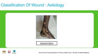 Wound Care Training Module for Primary Health Care | Ministry of Health Malaysia
Classification Of Wound : Aetiology
Arterial Ulcer
 