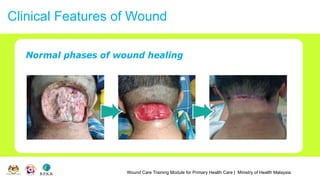 Wound Care Training Module for Primary Health Care | Ministry of Health Malaysia
Clinical Features of Wound
 