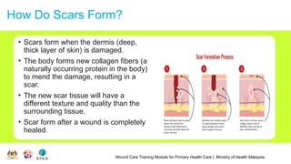 Wound Care Training Module for Primary Health Care | Ministry of Health Malaysia
How Do Scars Form?
• Scars form when the dermis (deep,
thick layer of skin) is damaged.
• The body forms new collagen fibers (a
naturally occurring protein in the body)
to mend the damage, resulting in a
scar.
• The new scar tissue will have a
different texture and quality than the
surrounding tissue.
• Scar form after a wound is completely
healed.
 