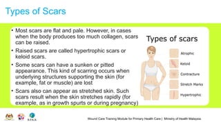 Wound Care Training Module for Primary Health Care | Ministry of Health Malaysia
Types of Scars
• Most scars are flat and pale. However, in cases
when the body produces too much collagen, scars
can be raised.
• Raised scars are called hypertrophic scars or
keloid scars.
• Some scars can have a sunken or pitted
appearance. This kind of scarring occurs when
underlying structures supporting the skin (for
example, fat or muscle) are lost
• Scars also can appear as stretched skin. Such
scars result when the skin stretches rapidly (for
example, as in growth spurts or during pregnancy)
 