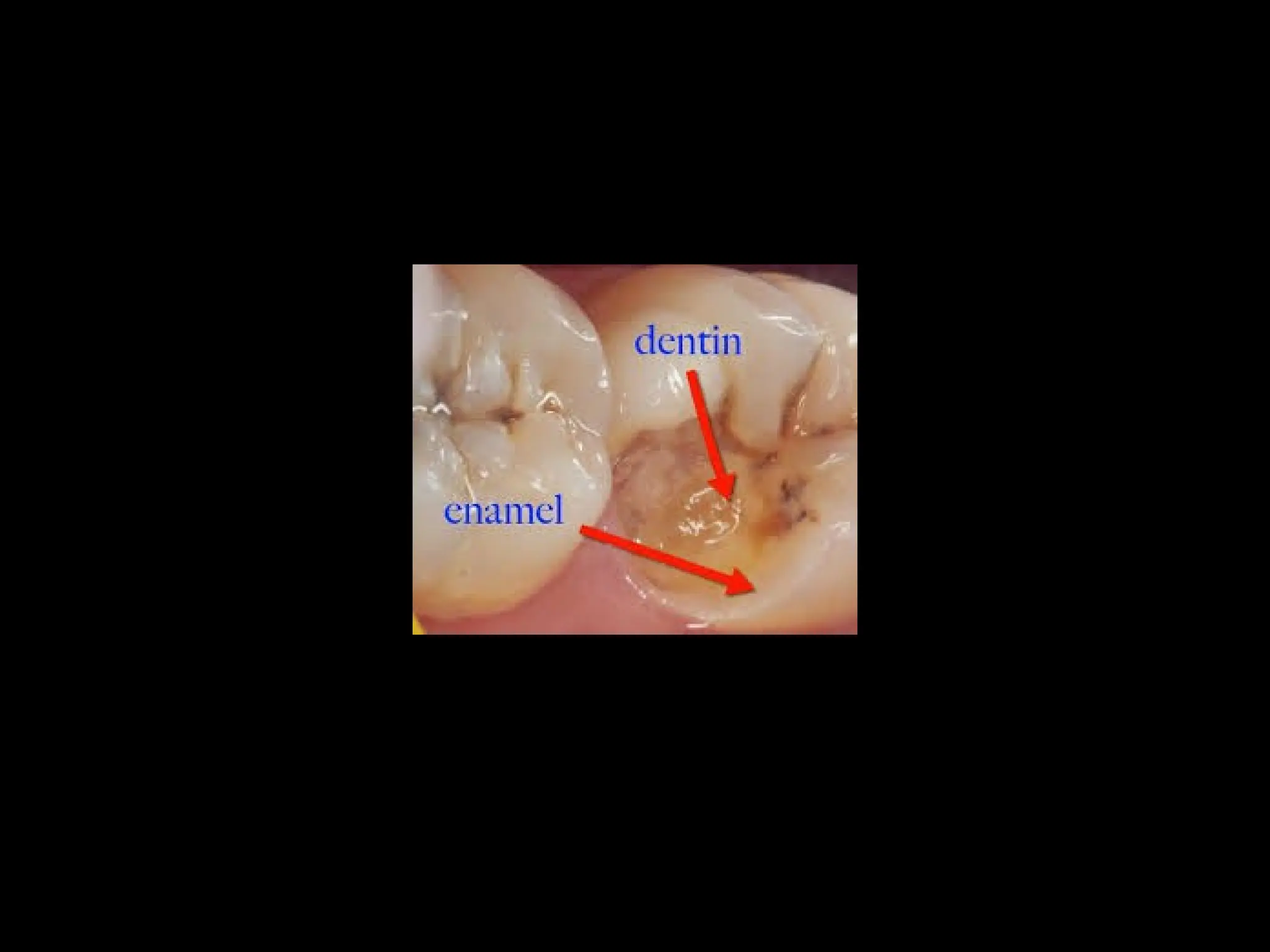 1. Dentin structure of toothtypes of dentin inter | PPTX