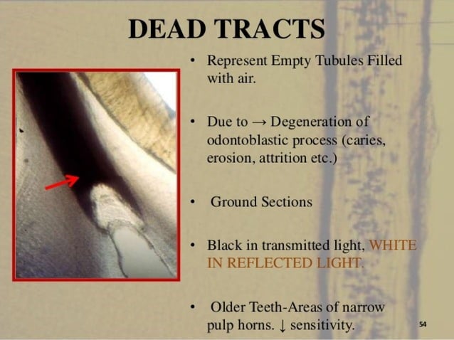 1. Dentin structure of toothtypes of dentin inter | PPT