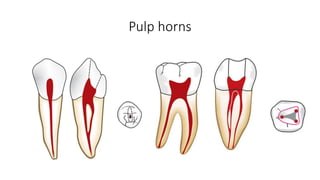 Pulp horns
 