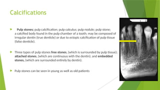 Calcifications
 Pulp stones; pulp calcification; pulp calculus; pulp nodule; pulp stone;
a calcified body found in the pulp chamber of a tooth; may be composed of
irregular dentin (true denticle) or due to ectopic calcification of pulp tissue
(false denticle).
 Three types of pulp stones free stones, (which is surrounded by pulp tissue);
attached stones, (which are continuous with the dentin); and embedded
stones, (which are surrounded entirely by dentin);
 Pulp stones can be seen in young as well as old patients
 