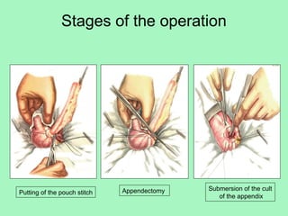 it is an inflammation of the vermiform appendix | PPT
