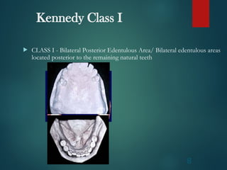 Classification of edentulous arches.ppt