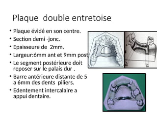Plaque double entretoise
• Plaque évidé en son centre.
• Section demi -jonc.
• Epaisseure de 2mm.
• Largeur:6mm ant et 9mm post.
• Le segment postérieure doit
reposer sur le palais dur .
• Barre antérieure distante de 5
a 6mm des dents piliers.
• Edentement intercalaire a
appui dentaire.
 