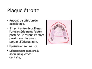Plaque étroite
• Répond au principe de
décolletage.
• S’inscrit entre deux lignes,
l’une antérieure et l’autre
postérieure reliant les faces
proximales des dents
bordant l’édentement.
• Épaissie en son centre.
• Edentement encastre a
appui uniquement
dentaire;
 