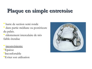 Plaque en simple entretoise
Plaque en simple entretoise
 barre de section semi ronde
 dans partie médiane ou postérieure
du palais.
 édentement intercalaire de très
faible étendue
 inconvénients:
Epaisse
Inconfortable
Eviter son utilisation
 