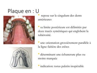Plaque en : U
 repose sur le cingulum des dents
antérieures
 sa limite postérieure est délimitée par
deux tracés symétriques qui englobent la
tubérosité.
 une orientation grossièrement parallèle à
la ligne faitière des crêtes
 déterminant une échancrure plus ou
moins marquée
 indication: torus palatin inopérable
 