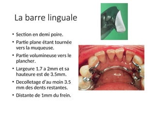 La barre linguale
• Section en demi poire.
• Partie plane étant tournée
vers la muqueuse.
• Partie volumineuse vers le
plancher.
• Largeure 1.7 a 2mm et sa
hauteure est de 3.5mm.
• Decolletage d’au moin 3.5
mm des dents restantes.
• Distante de 1mm du frein.
 