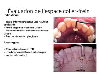 Évaluation de l’espace collet-frein
Indications:
- Table interne présente une hauteur
suffisante
- Frein lingual à insertion basse
- Plancher buccal dans une situation
basse
- Pas de récession gingivale
Avantages:
- Permet une bonne HBD
- Une bonne résistance mécanique
- confort du patient
 