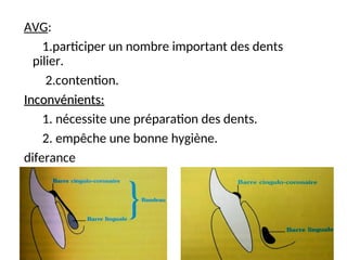AVG:
1.participer un nombre important des dents
pilier.
2.contention.
Inconvénients:
Inconvénients:
1. nécessite une préparation des dents.
2. empêche une bonne hygiène.
diferance
 