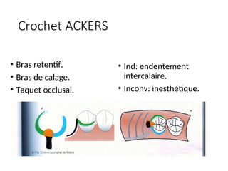Crochet ACKERS
• Bras retentif.
• Bras de calage.
• Taquet occlusal.
• Ind: endentement
intercalaire.
• Inconv: inesthétique.
 