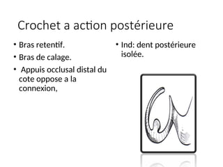 Crochet a action postérieure
• Bras retentif.
• Bras de calage.
• Appuis occlusal distal du
cote oppose a la
connexion,
• Ind: dent postérieure
isolée.
 