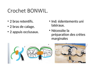 Crochet BONWIL.
• 2 bras retentifs.
• 2 bras de calage.
• 2 appuis occlusaux.
• Ind: édentements uni
latéraux.
• Nécessite la
préparation des crêtes
marginales
 