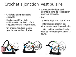 Crochet a jonction vestibulaire
• Crochet a point de départ
gingivale.
• Il existe un élément de
stabilisation placé sur la face
linguale assurant la réciprocité.
• Un bras vestibulaire long se
termine par un bras flexible
• AVANG: esthétique car il
aborde la zone de retrait selon
une voie cervicale.
• INC:
1. ceinturage n’est pas assuré.
2.le trajet du crochet est
défavorable pour le parodonte.
3.La position vestibulaire du
bras de rétention peut irriter la
lèvre.
 