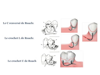 Le C renversé de Roach:
Le crochet L de Roach:
Le crochet U de Roach
 